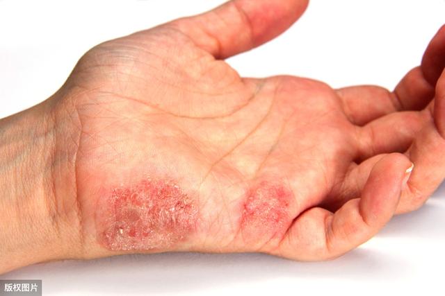 瘙痒、红肿起疹子？夏季来临，送你5种常见皮肤病的预防方法