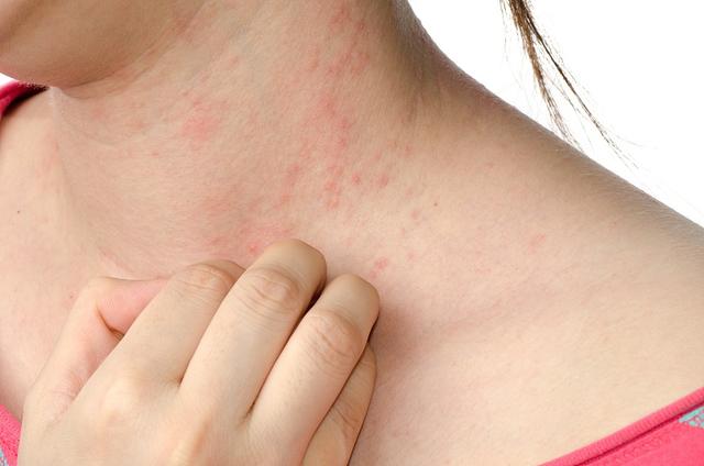 湿疹不是因为湿而是因为干，那为啥还叫湿疹？湿疹高发季如何保湿