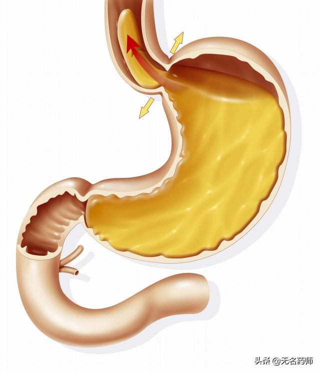 胃部灼烧疼痛,医生:可能是胃食管反流,需从这些方面注意