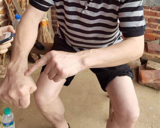 时隔二十多年,张玉环身上依然留着当年的伤痕。图片来源:梁宙/摄