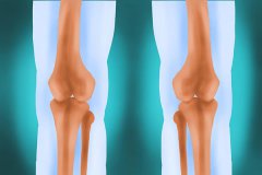 膝关节突然出现的积液是什么？