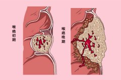 喉癌并非没有征兆，身体早已经不断提