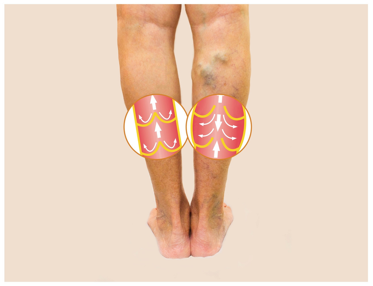 腿部出现三个征兆，说明血管已经变窄，远离血栓，应有三个习惯