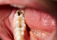 究竟是什么置牙齿于危险之中？又该如