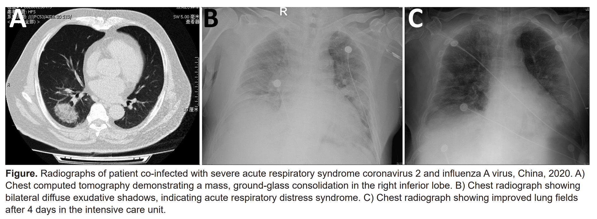 我国某合并感染患者的X线照片，曾显示双侧弥漫性渗出阴影，提示急性呼吸窘迫综合征。图源/研究论文