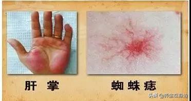 肝不好,身体会有5种表现,如果没有,恭喜,你的肝挺健康