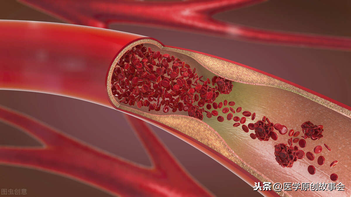 血栓不是突然到来,患上血栓的人,晚上常常有四个共同点