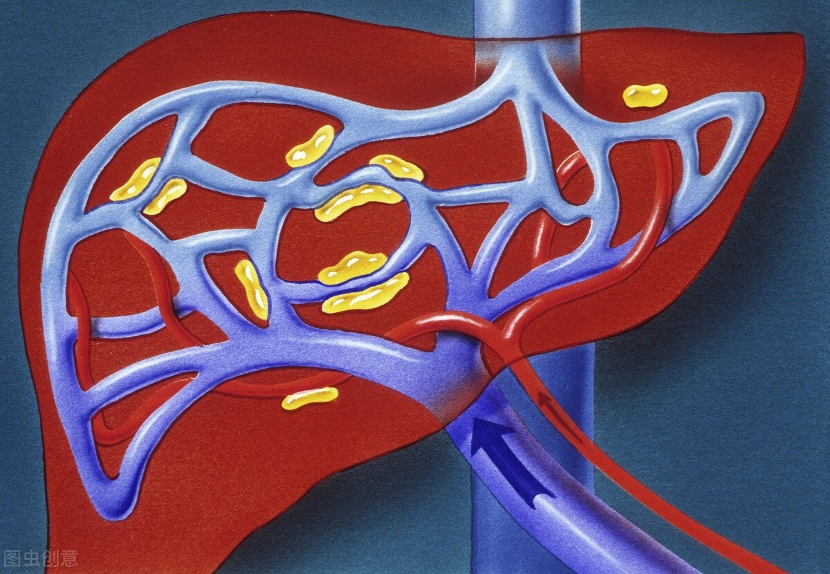 肝硬化如何才能提早发现呢？医生告诉你5个症状，越早发现越好
