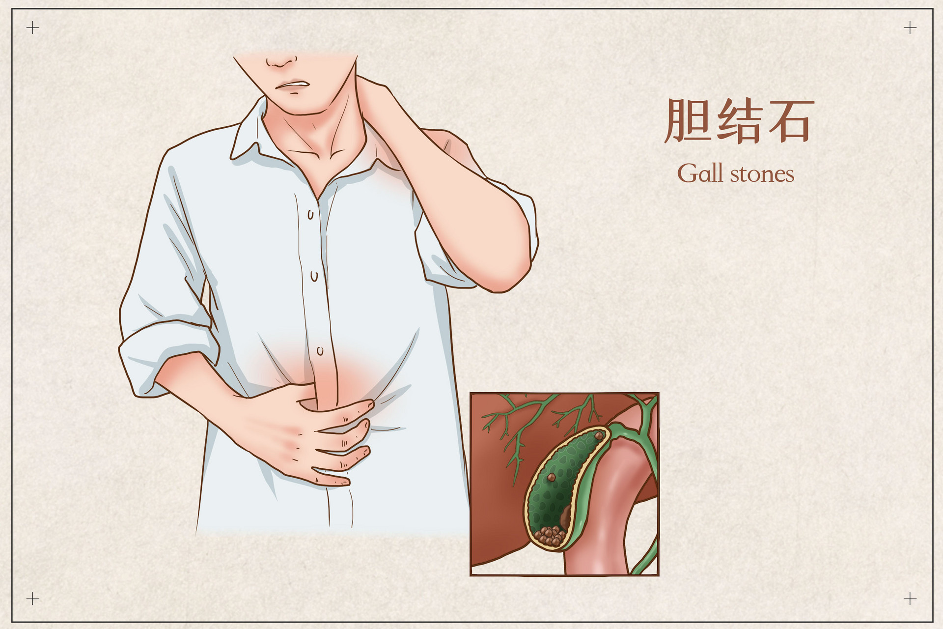 市一医院肝胆科三镜联合微创治疗胆管结石_自贡市第一人民医院