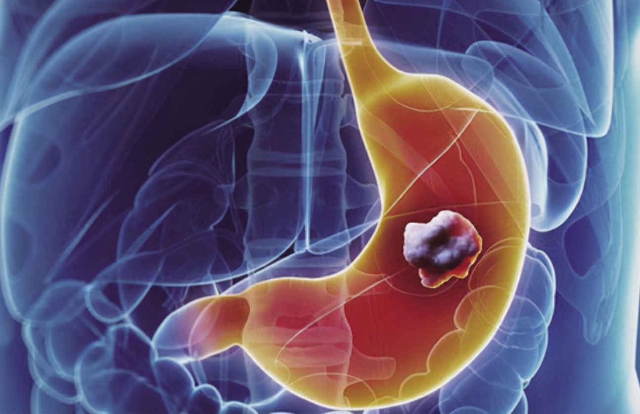 胃癌早期不痛不痒，但有4个“信号”，多半是胃癌来了