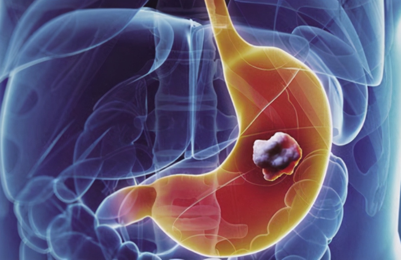 患上胃癌的5个症状
