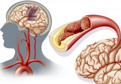 轻度脑梗“早期”可能有的5个症状