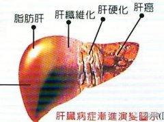 肝癌早期身体会发出这些信号