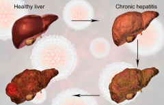 如何阻止乙肝恶化成肝硬化、肝癌？