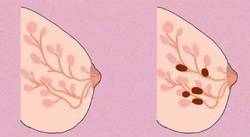 为什么说中医药治疗乳腺结节不易复发？肿瘤专家：这两方面是根源