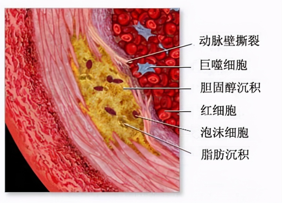 颈动脉斑块不能跑步,否则有破裂引发脑梗的风险!医生辟谣讲清楚