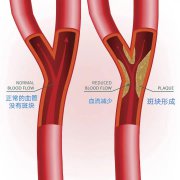 颈动脉斑块对身体有什么不良影响？