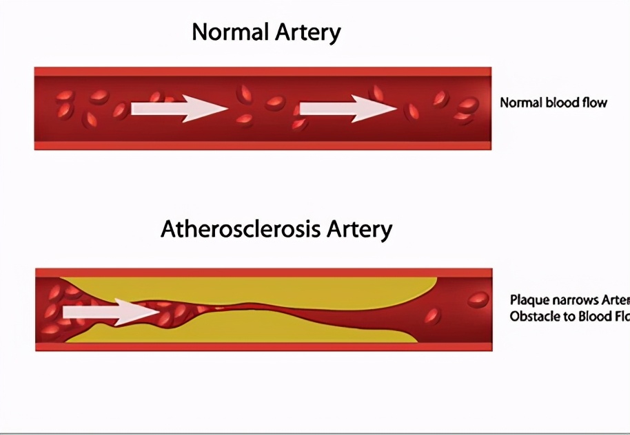 血脂高必须吃药，不然会患心脏病或脑梗！医生辟谣讲清楚关键问题