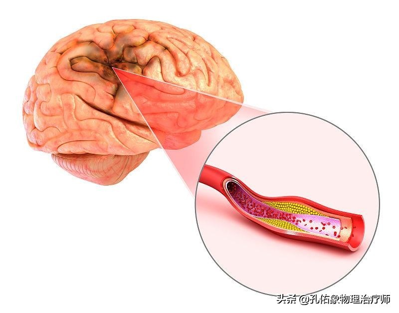 为何如此多的人发生脑梗?要怎么正确应对?一文给您详细讲清楚