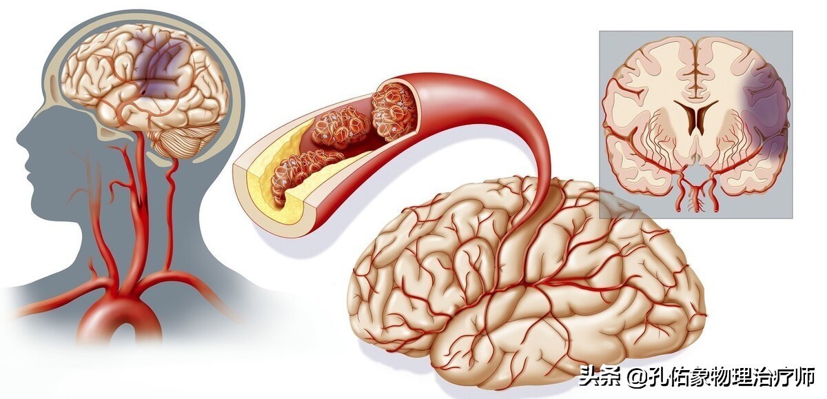 为何如此多的人发生脑梗?要怎么正确应对?一文给您详细讲清楚