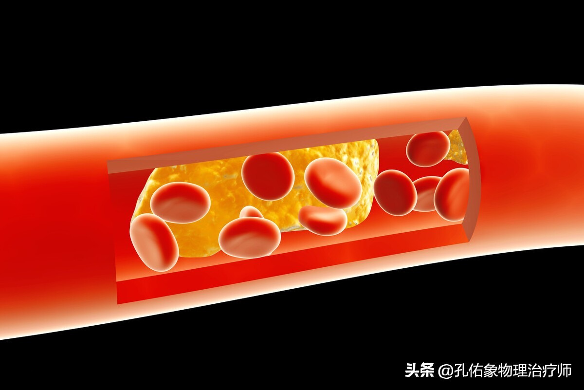 为何如此多的人发生脑梗?要怎么正确应对?一文给您详细讲清楚