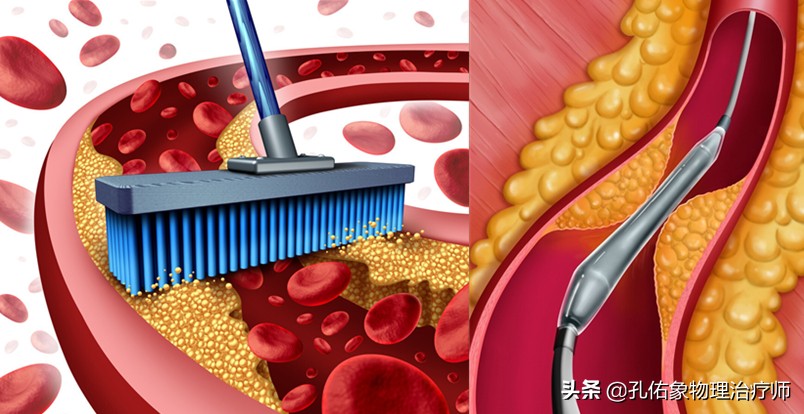 为何如此多的人发生脑梗?要怎么正确应对?一文给您详细讲清楚