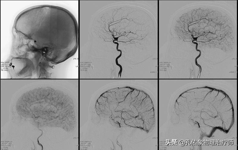 为何如此多的人发生脑梗?要怎么正确应对?一文给您详细讲清楚