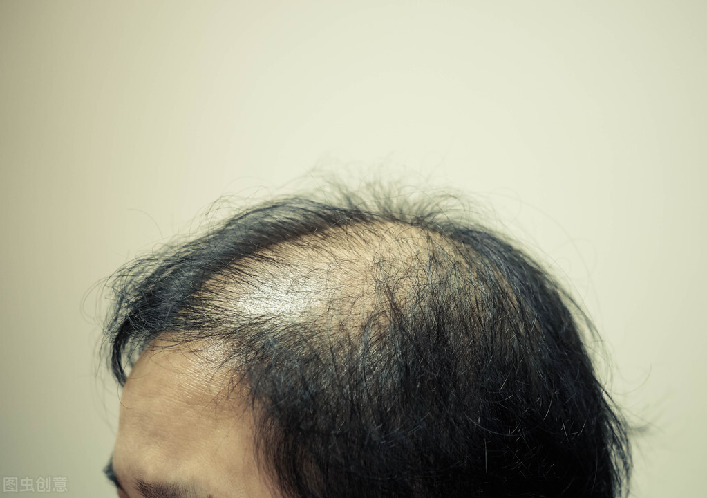 我那么年轻怎么会脱发?有可能你缺乏这5种维生素,对照补一下吧