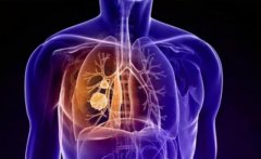 当冠心病与肺癌双病缠身，去哪治？