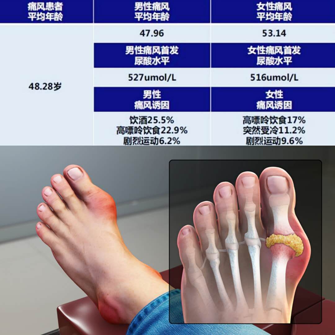 医生辟谣:体内的尿酸只有20%来自于食物,所以控制饮食没有用