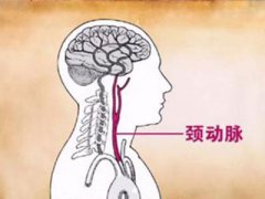 老年人是不是都会长颈动脉斑块？要紧