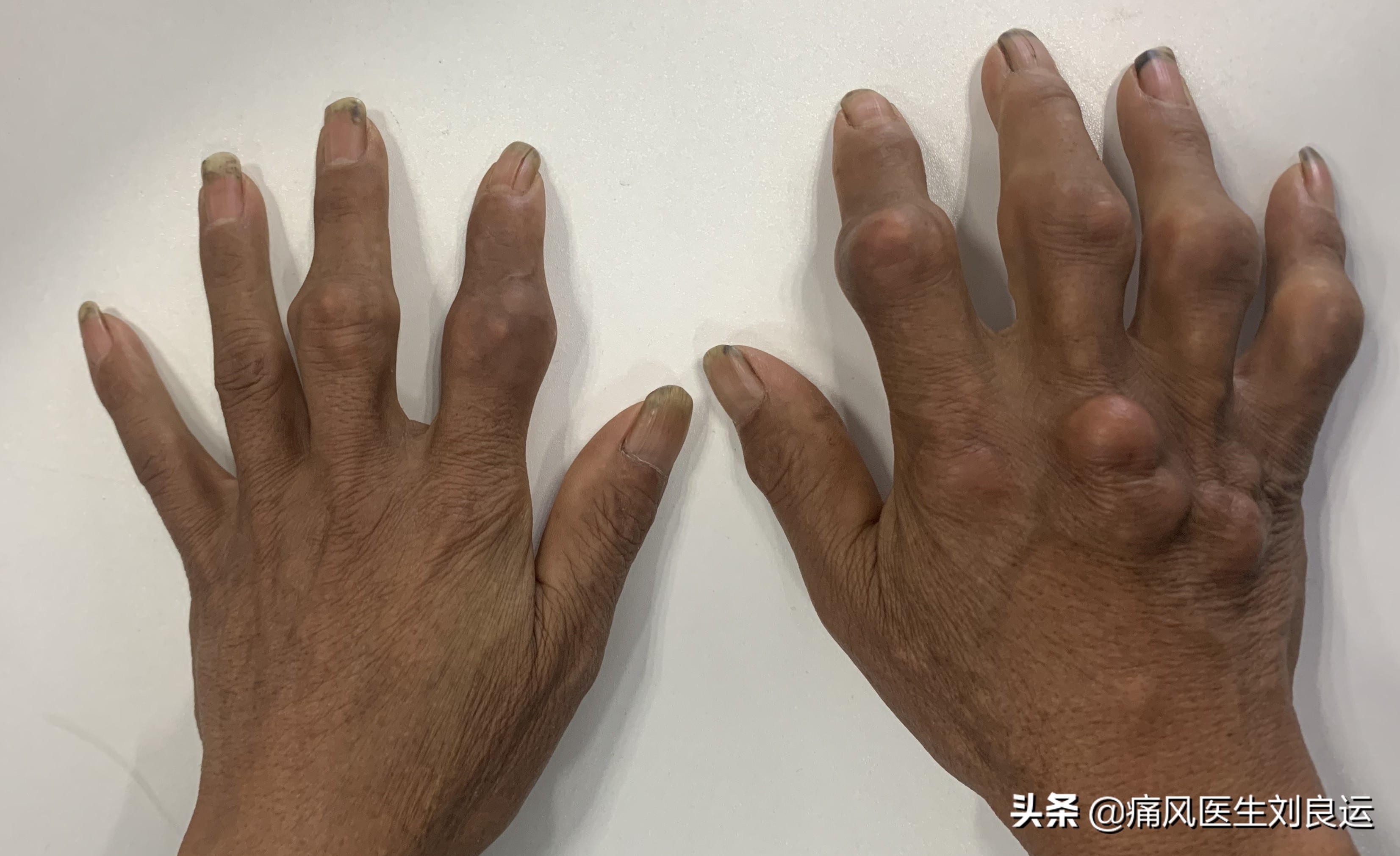 痛风是吃出来的病?尿酸高还是喝出来、累出来、懒出来和胖出来的