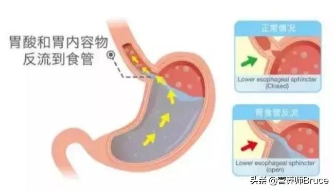 胃胀、胃反酸、胃溃疡,可以吃什么食物缓解胃酸过多?