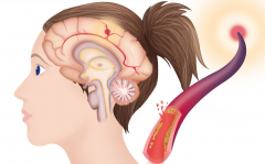 手脚发麻、说话不清，中风前的身体警