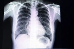 随着低剂量CT的普及，肺结节的检出率也