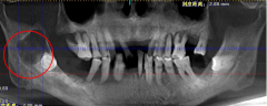 牙龈“长包”要重视，小心是根尖囊肿